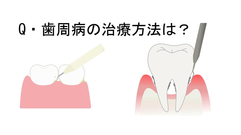 Ｑ＆Ａ　歯周病の治療方法は