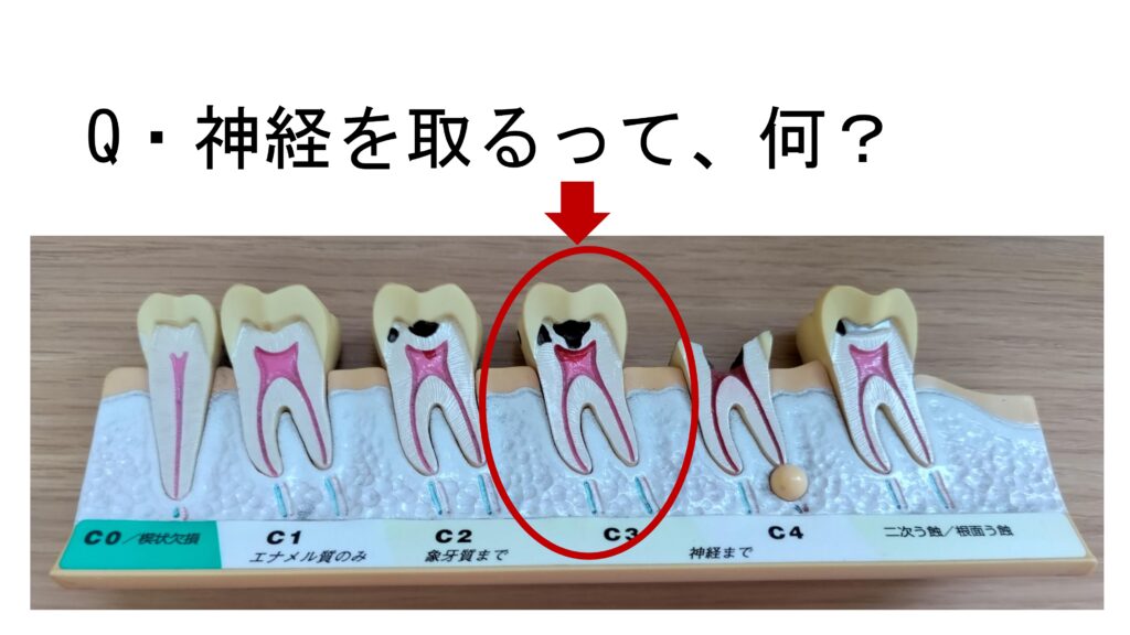Ｑ＆Ａ　神経を取るって、何？