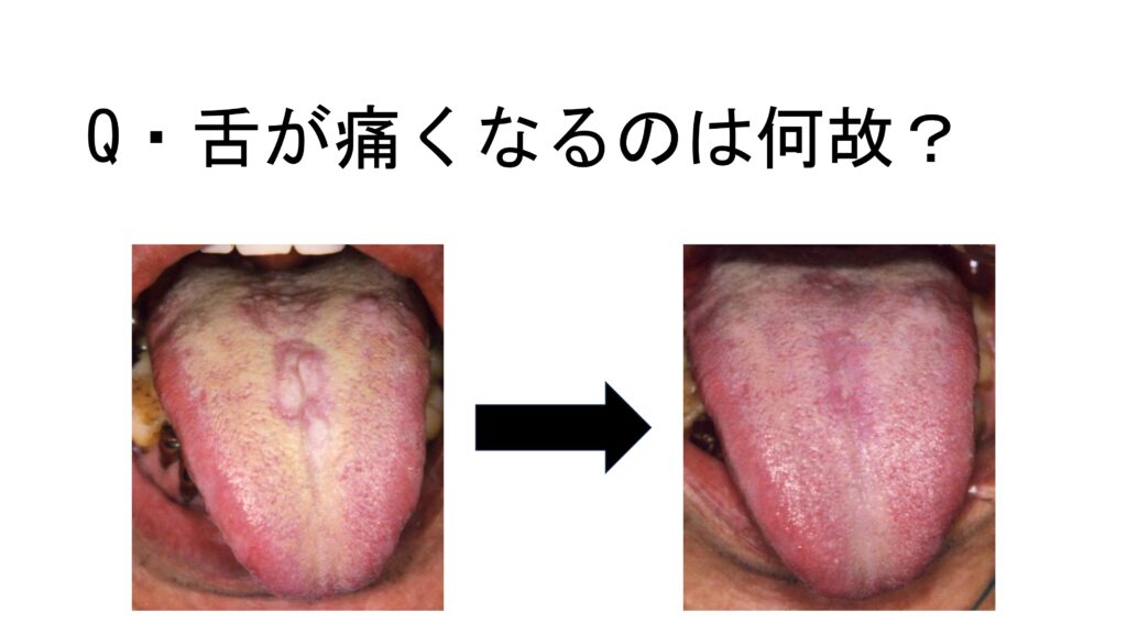 Ｑ＆Ａ　舌が痛くなるのは何故？